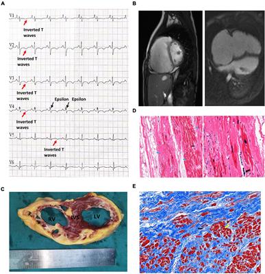 A rare case of arrhythmogenic right ventricular cardiomyopathy associated with LAMA2 mutation: A case report and literature review